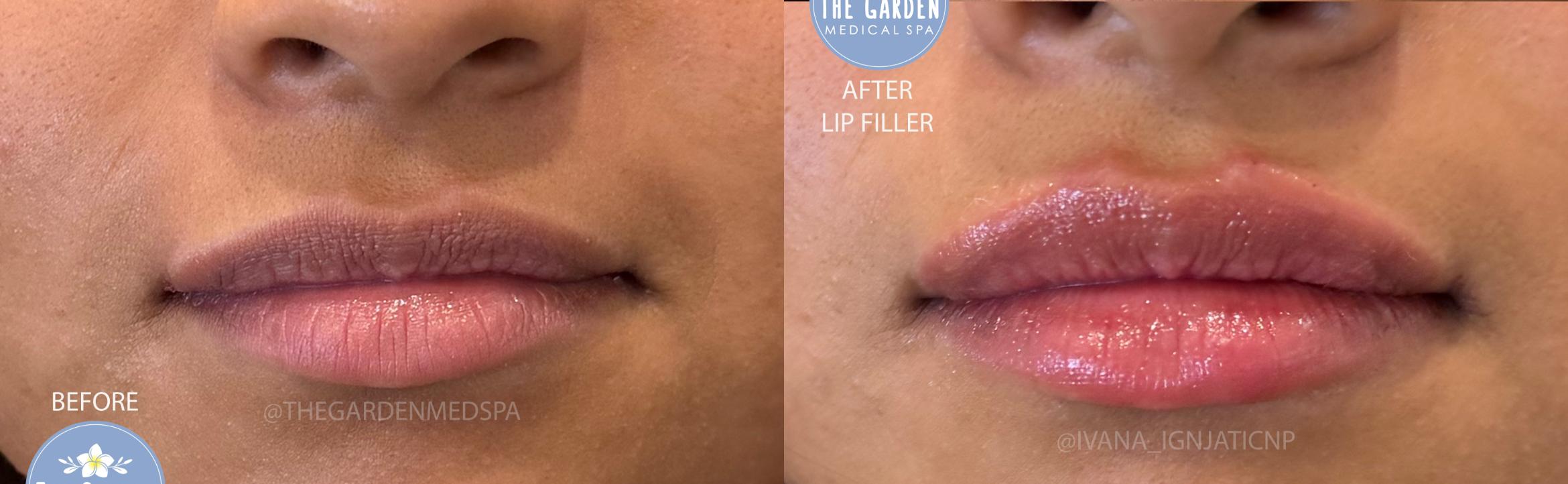 Lip Filler for Volume