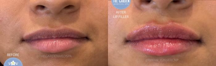 Lip Filler for Volume
