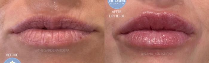 Lip Filer for Deep Hydration