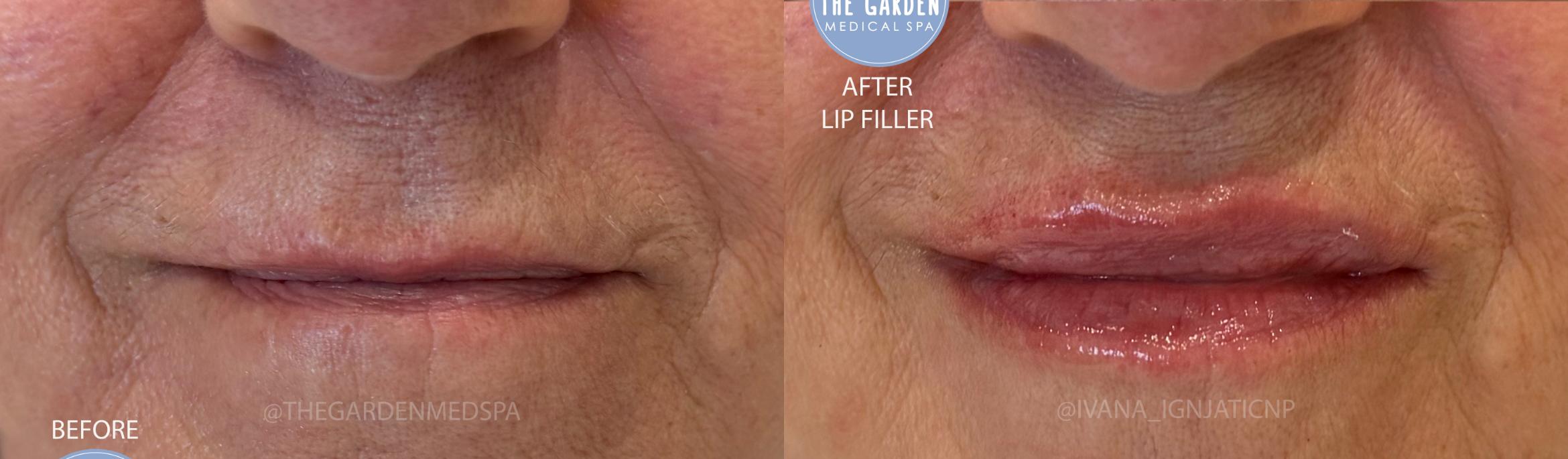 Lip Filler Volume and Hydration