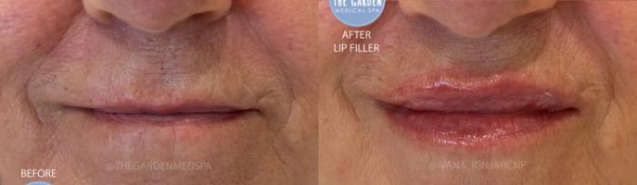 Lip Filler Volume and Hydration