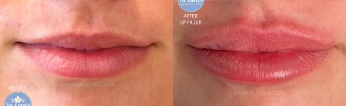 Lip Filler 