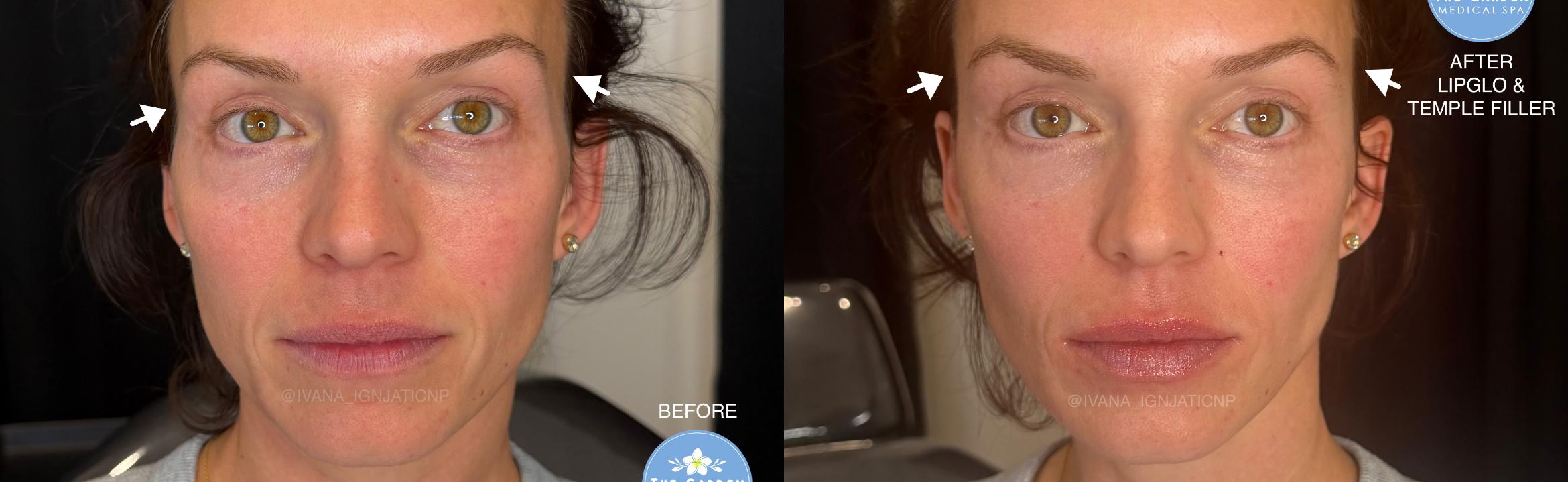 Temple Filler & LipGlo
