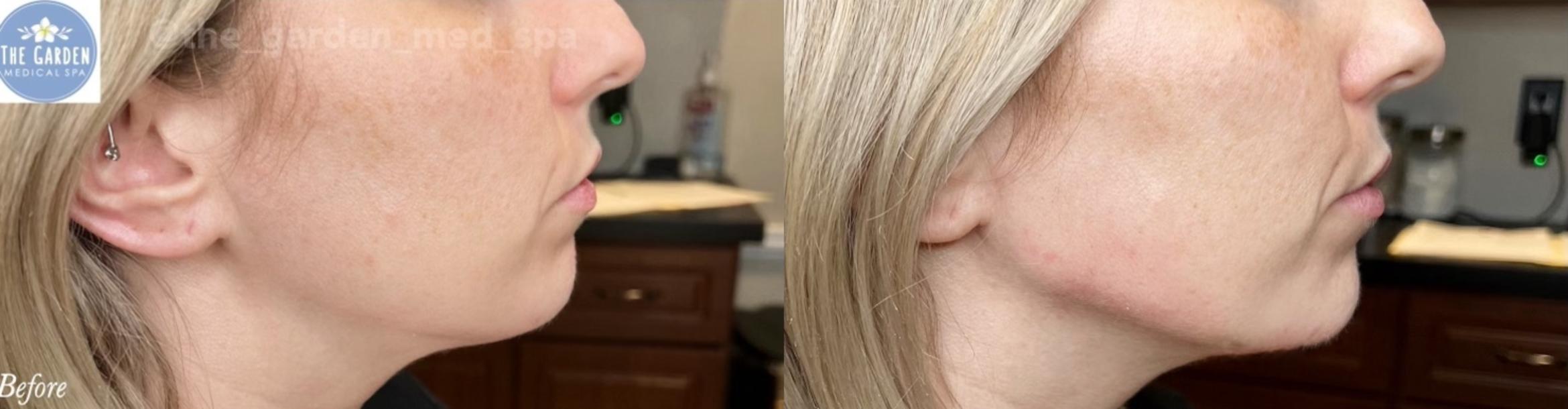 Before & After Dermal Fillers Client #19 Right Side View in Tampa Bay, North Palm Beach, FL