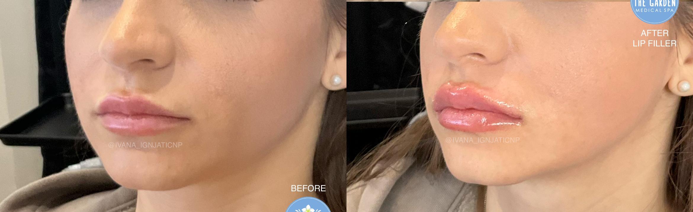 Lip Filler for Volume Enhancement