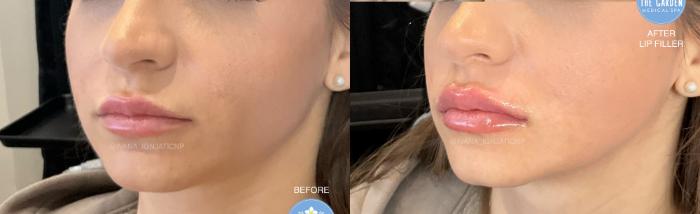 Lip Filler for Volume Enhancement