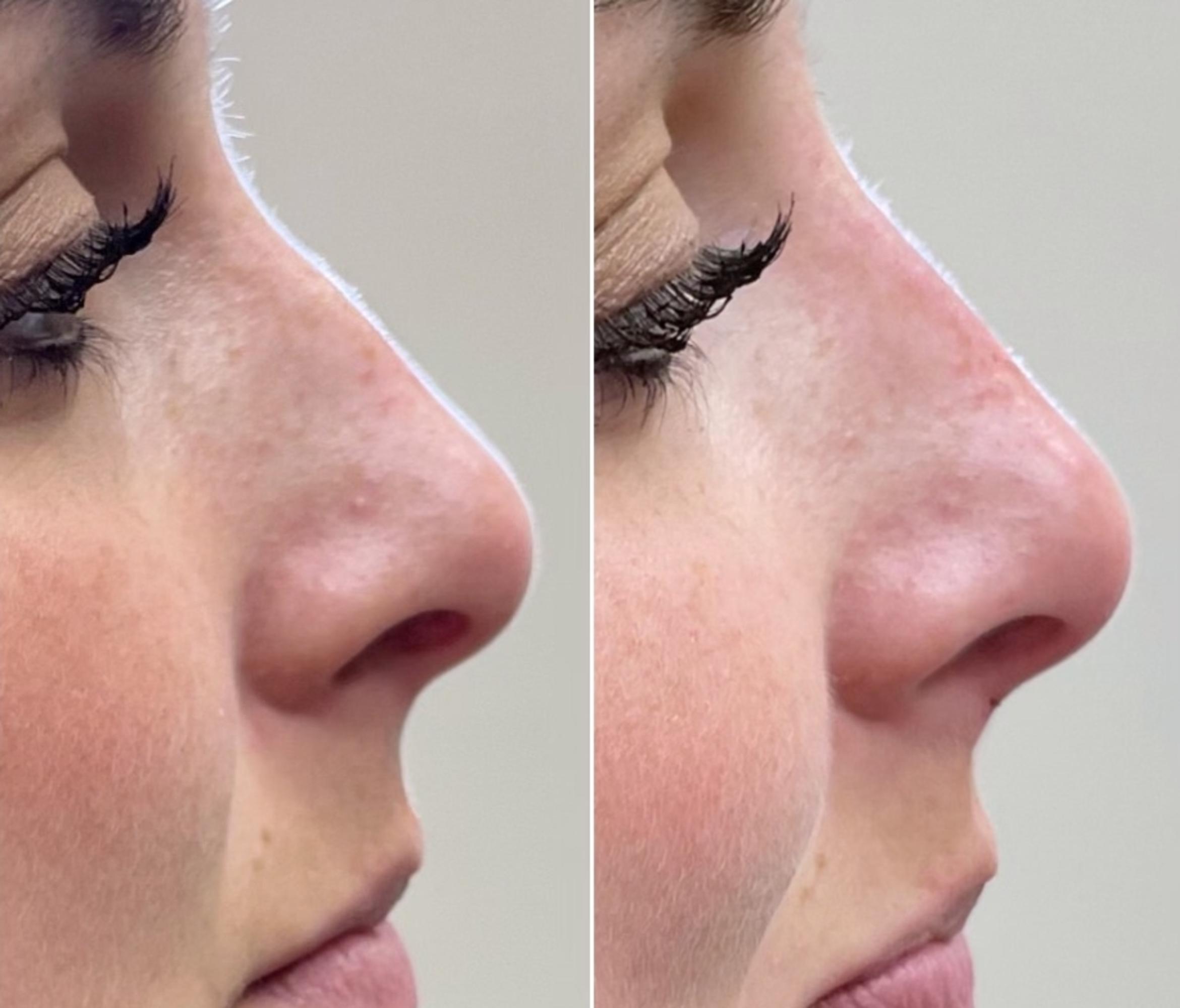 Before & After Dermal Fillers Client #22 Right Side View in Tampa Bay, North Palm Beach, FL