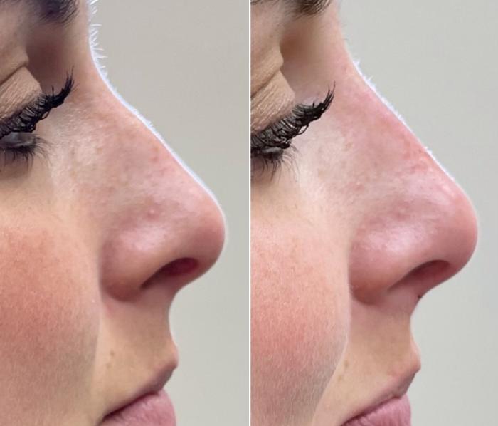 Before & After Dermal Fillers Client #22 Right Side View in Tampa Bay, North Palm Beach, FL