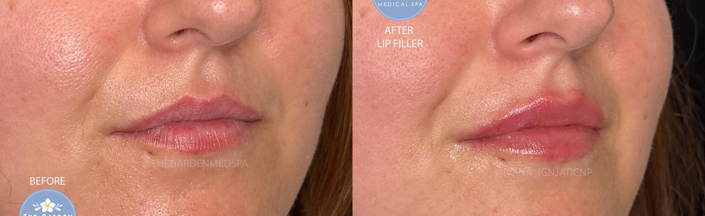 Hydrated Lip Filler