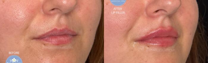 Hydrated Lip Filler
