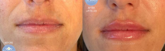 First Time Lip Filler