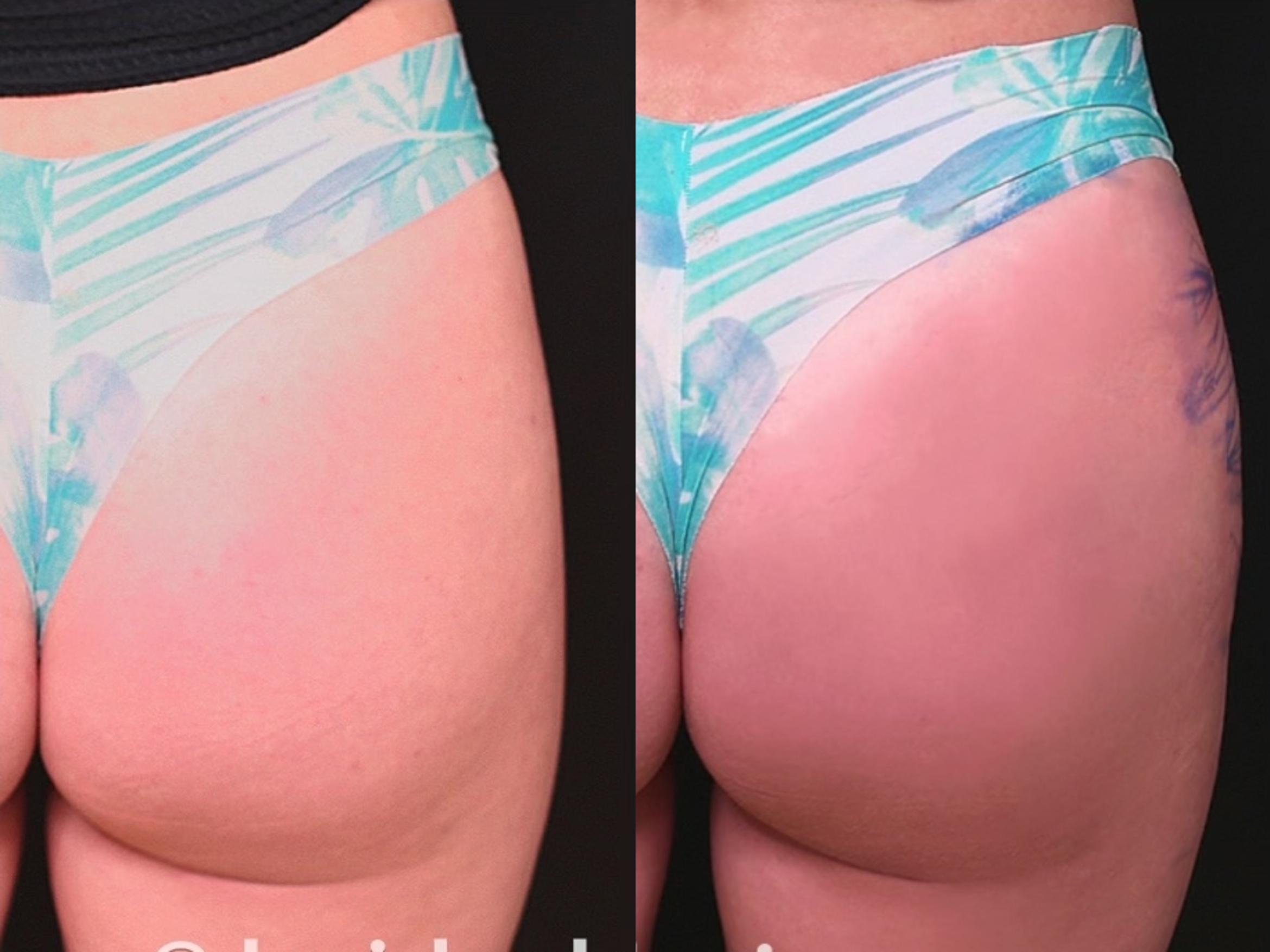 Before & After Dermal Fillers Client #24 Back View in Tampa Bay, North Palm Beach, FL