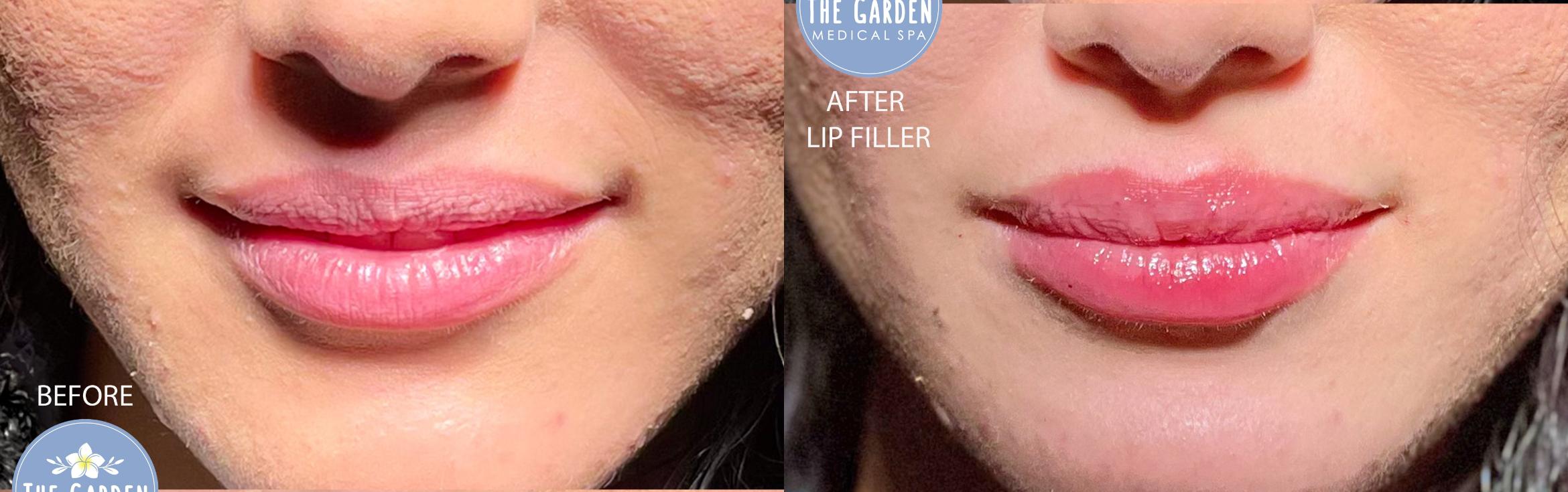 Lip Filler for Instant Hydration