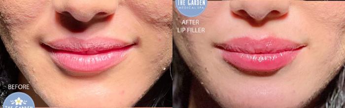 Lip Filler for Instant Hydration