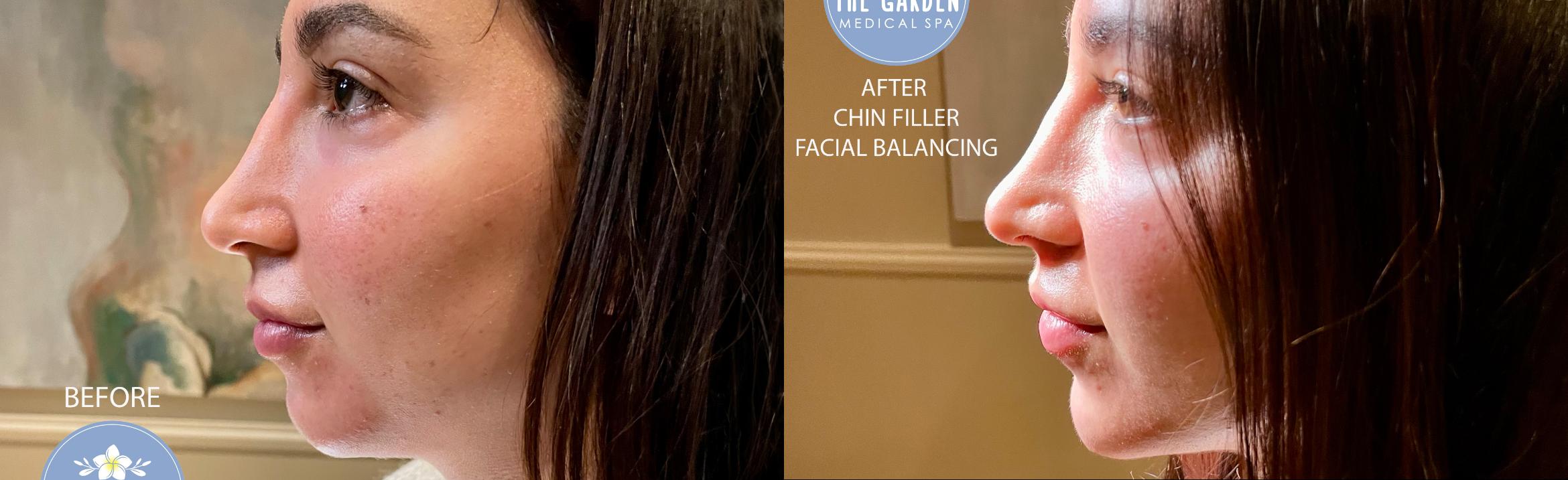 Facial Balancing Chin Filler