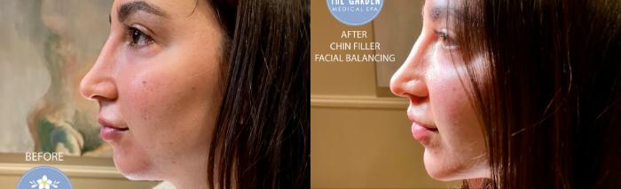 Facial Balancing Chin Filler
