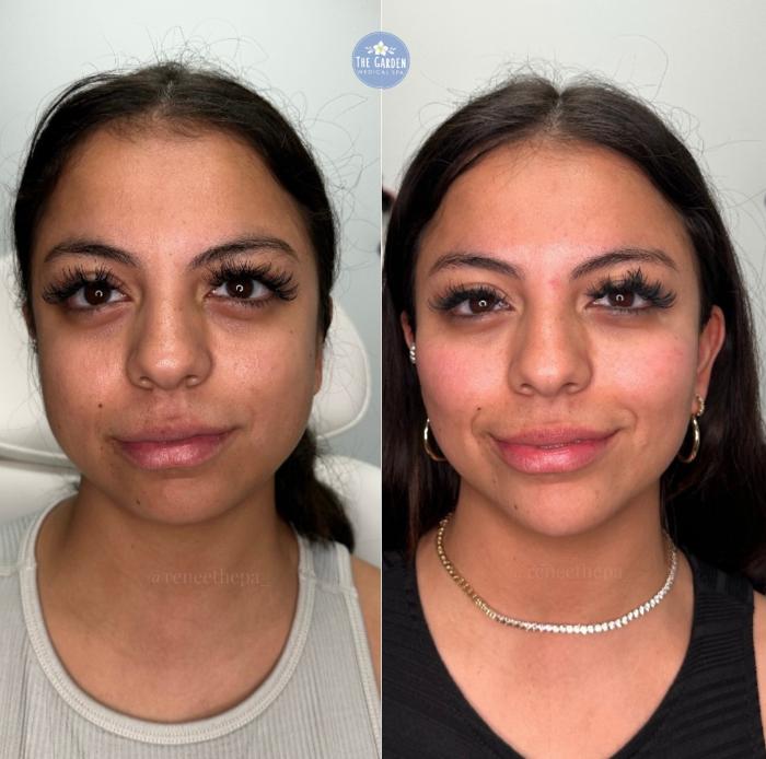 Before & After Dermal Fillers Client #47 Front View in Tampa Bay, North Palm Beach, FL