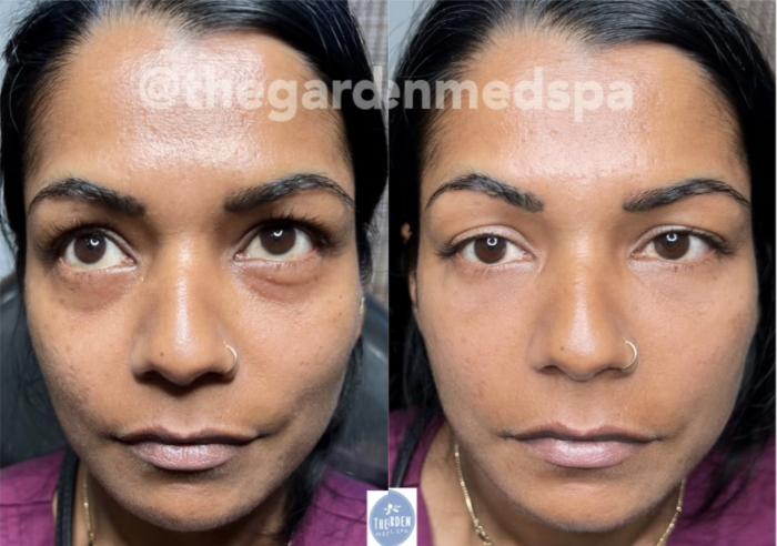 Before & After Dermal Fillers Client #6 Front View in Tampa Bay, North Palm Beach, FL