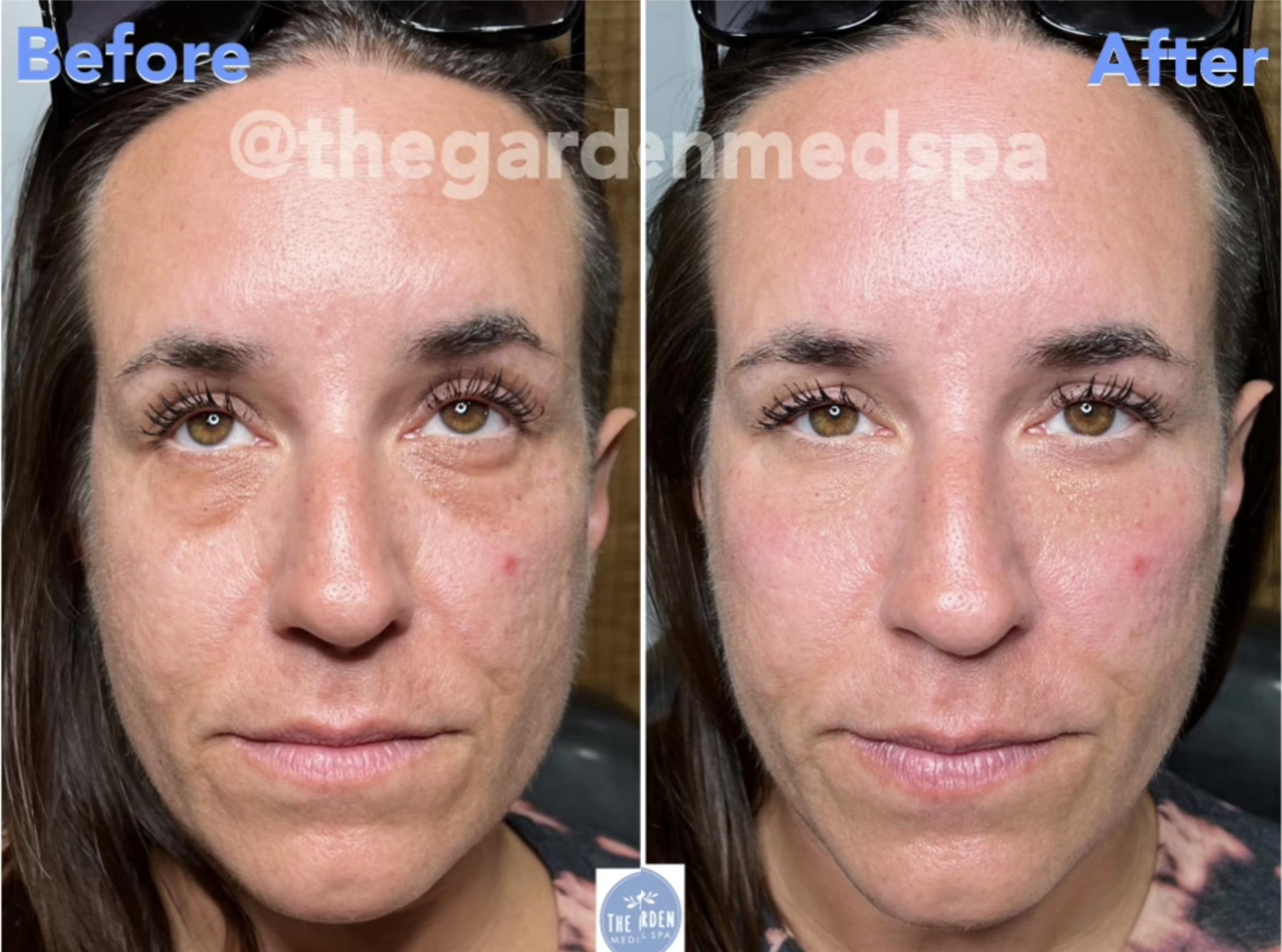 Before & After Dermal Fillers Client #7 Front View in Tampa Bay, North Palm Beach, FL