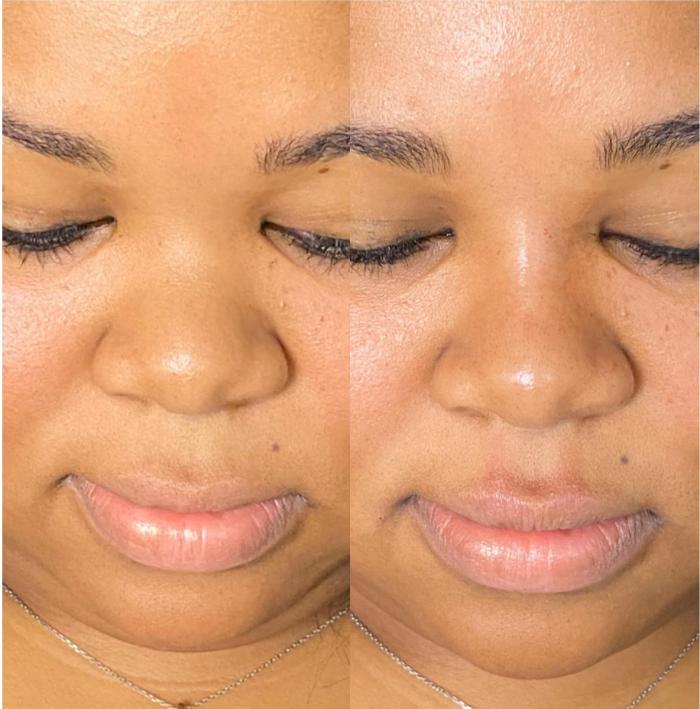 Liquid Rhinoplasty with Filler