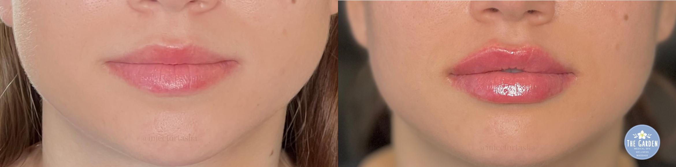 Before & After Dermal Fillers Client #9 Front View in Tampa Bay, North Palm Beach, FL