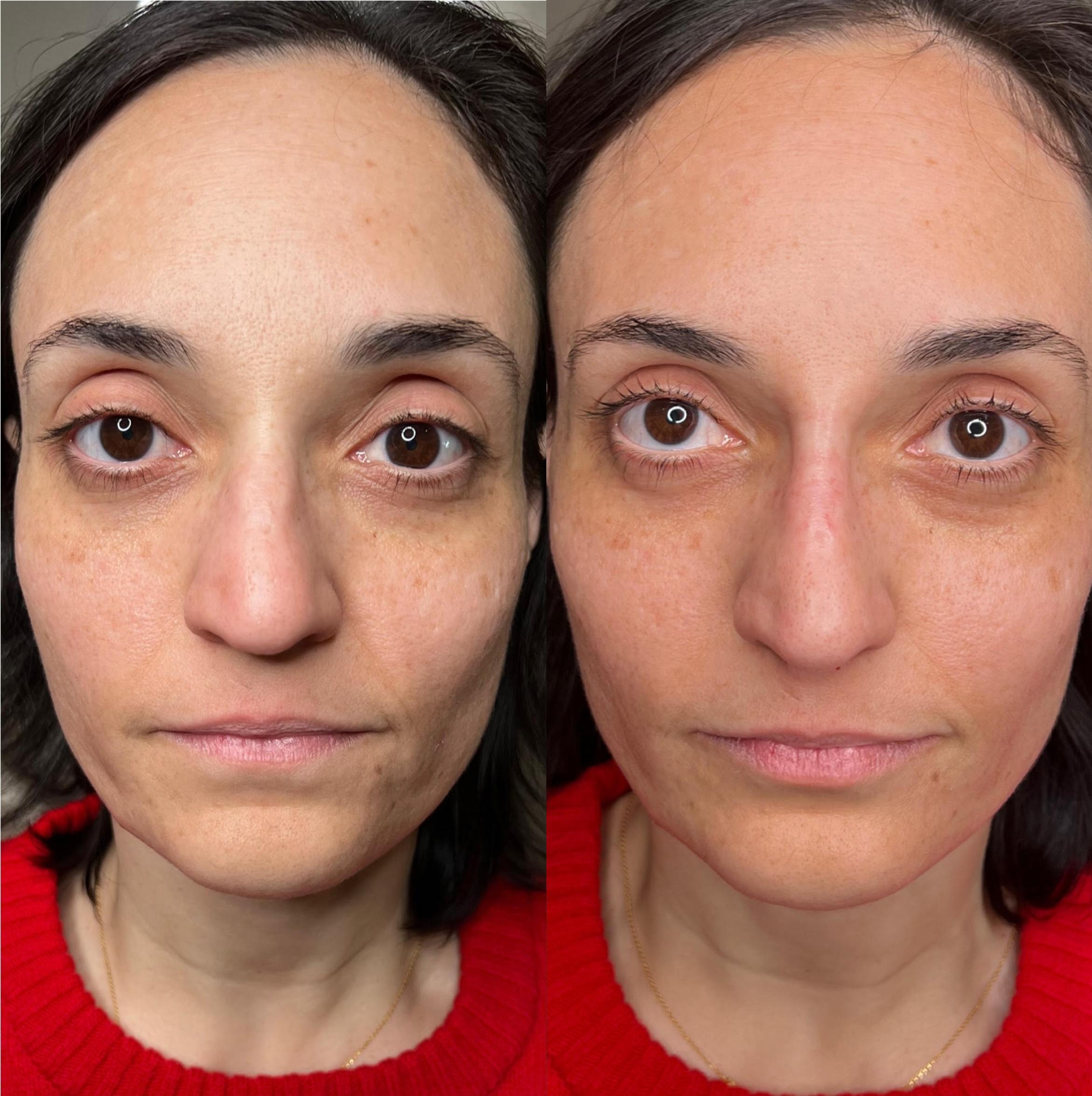 Liquid Rhinoplasty for Nose Bridge