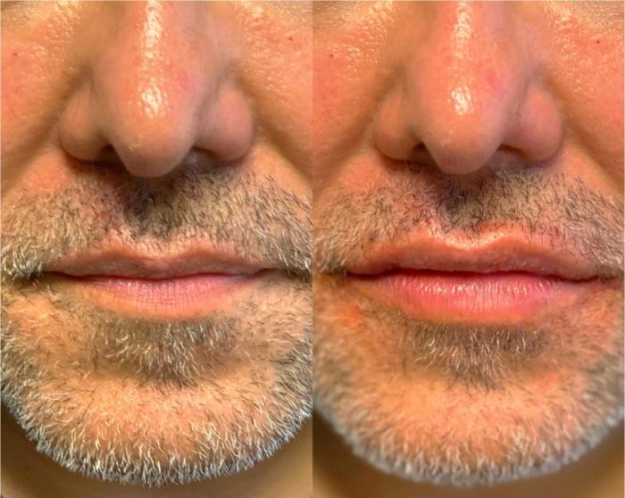 Before & After Dermal Fillers Client #92 Front View in Tampa Bay, North Palm Beach, FL