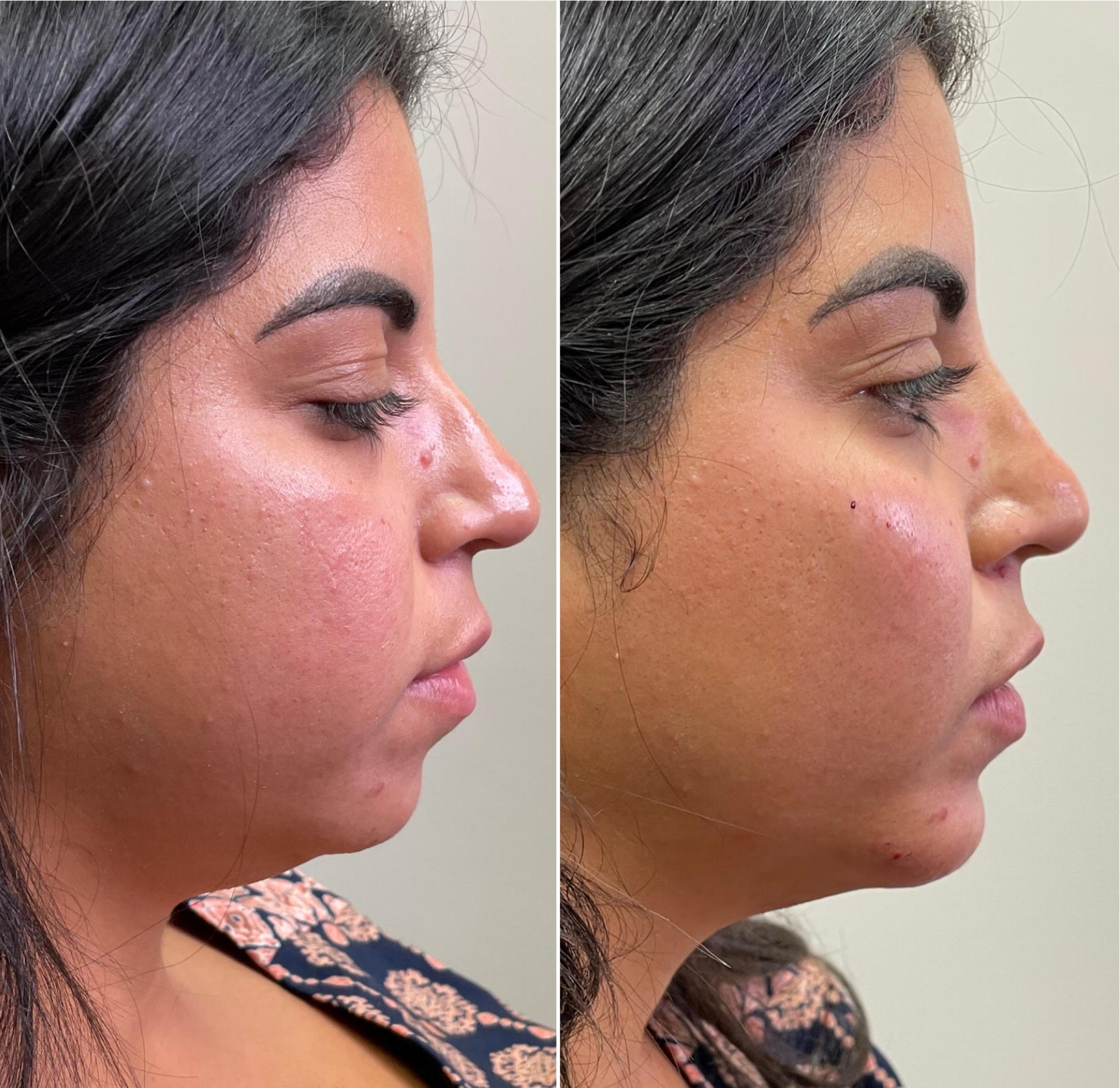 Before & After Dermal Fillers Client #93 Right Side View in Tampa Bay, North Palm Beach, FL