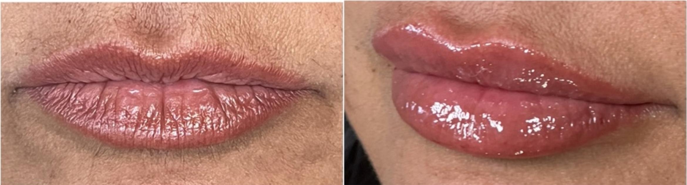 Hydrating Lip Filler