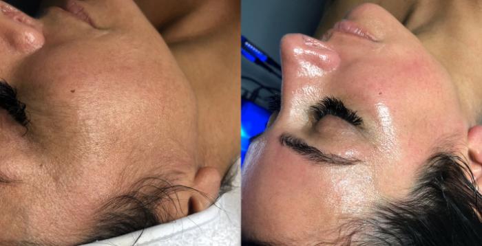 Dermaplaning Hydrafacial