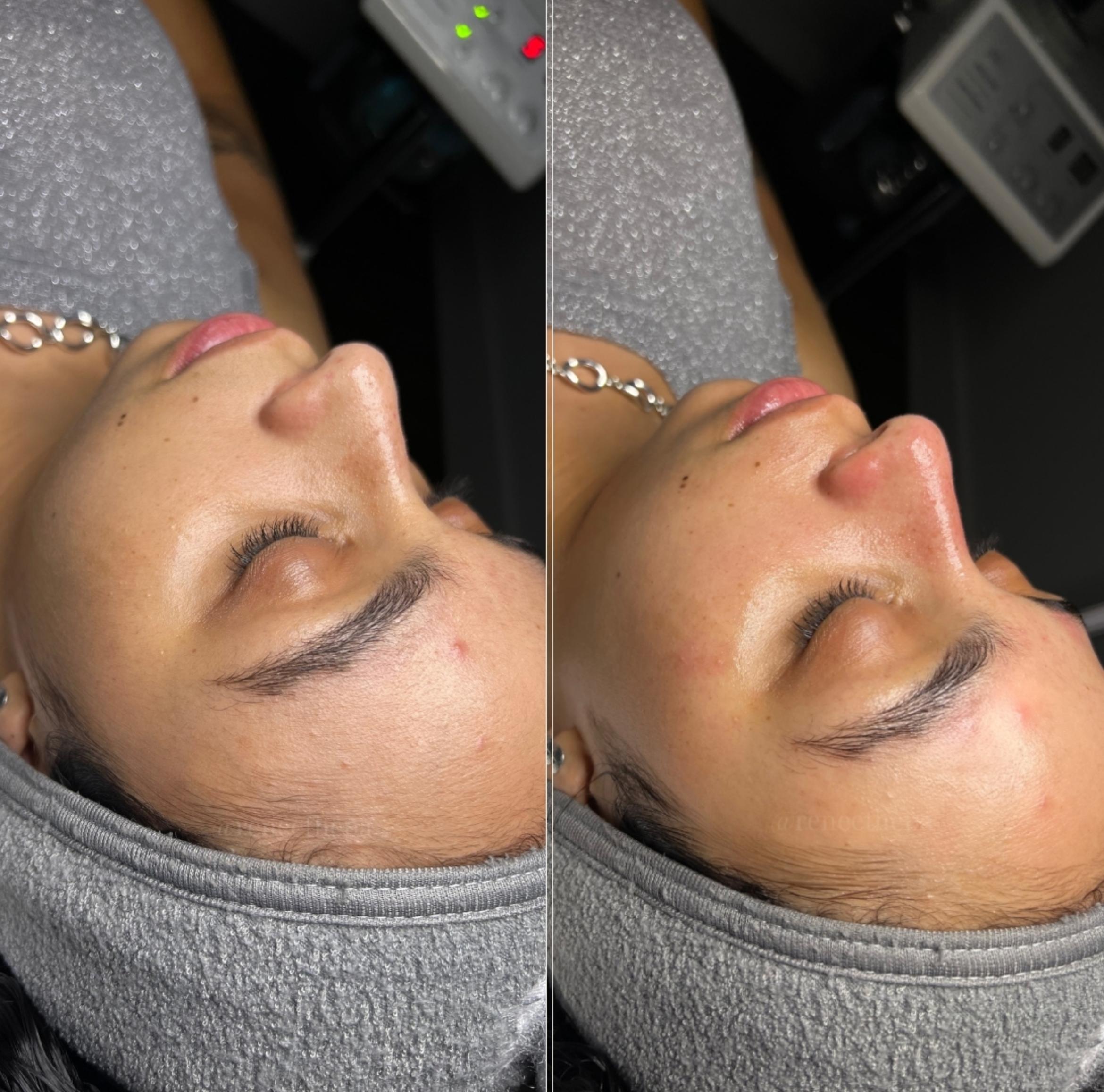 Before & After Dermaplaning Client #35 Left Side View in Tampa Bay, North Palm Beach, FL