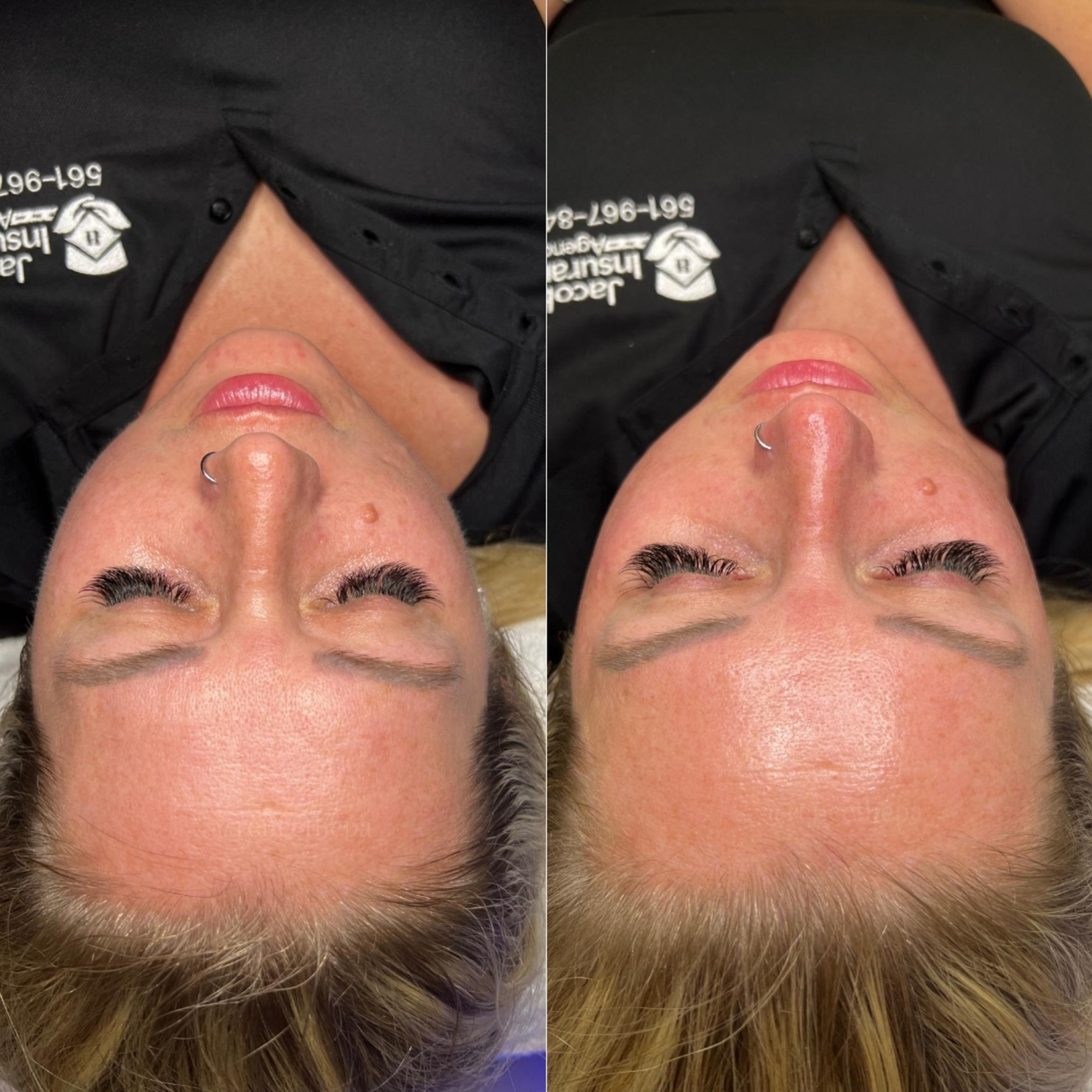 Before & After Facials Client #30 Front View in Tampa Bay, North Palm Beach, FL