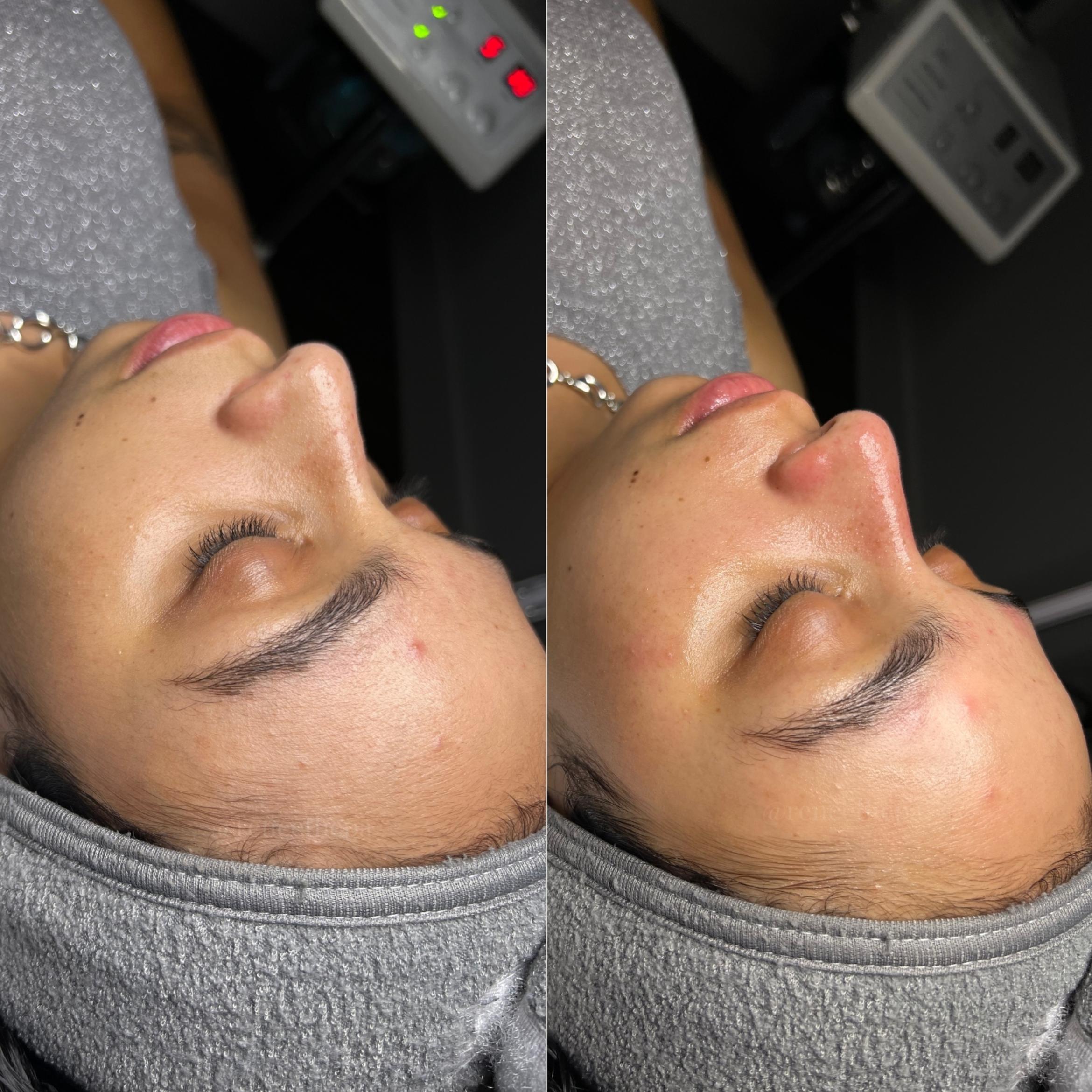 Before & After Facials Client #34 Left Side View in Tampa Bay, North Palm Beach, FL