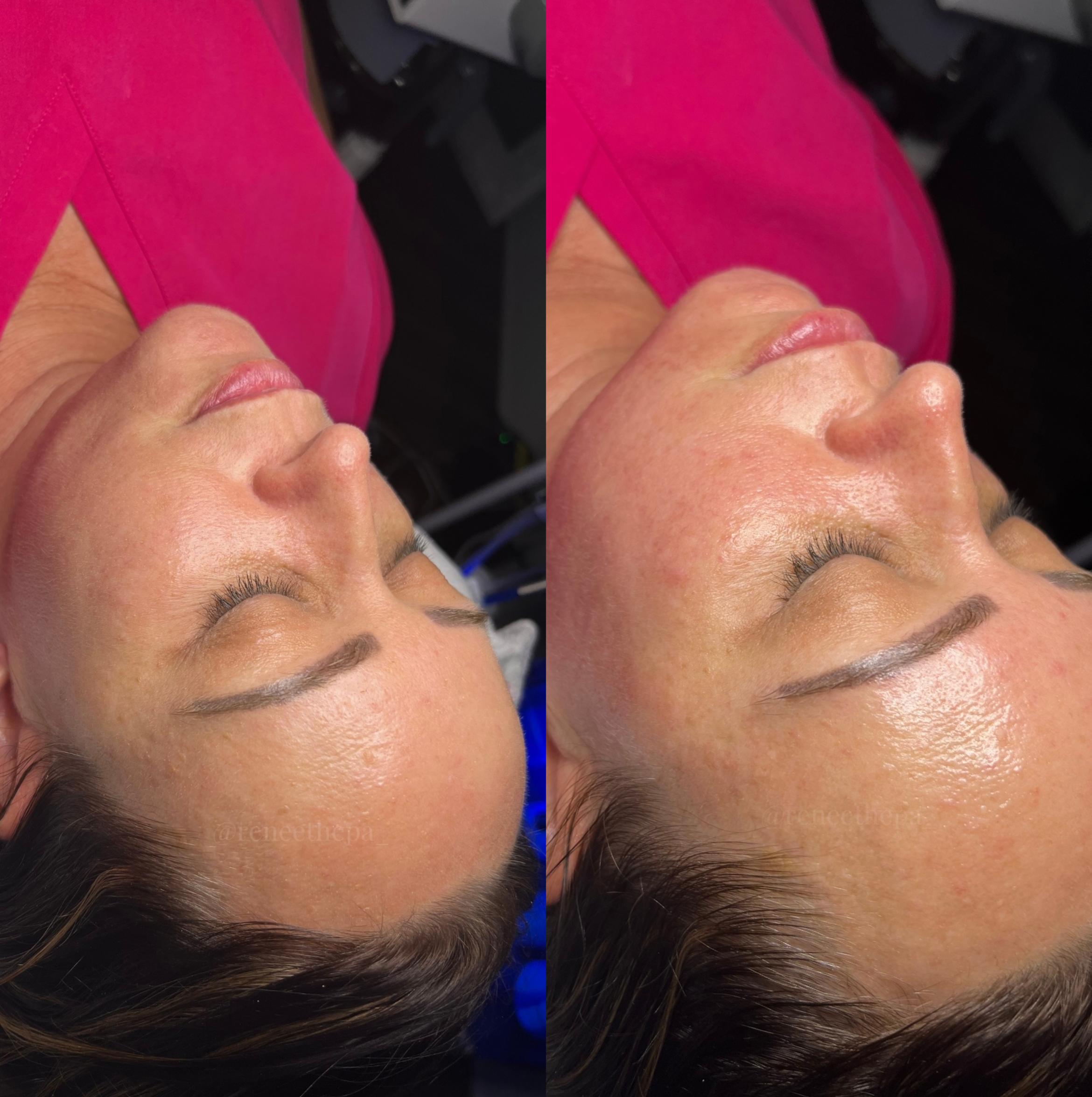 Before & After Facials Client #41 Left Side View in Tampa Bay, North Palm Beach, FL