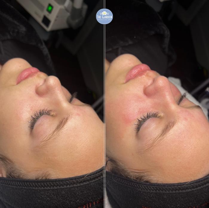 Before & After Facials Client #44 Left Side View in Tampa Bay, North Palm Beach, FL