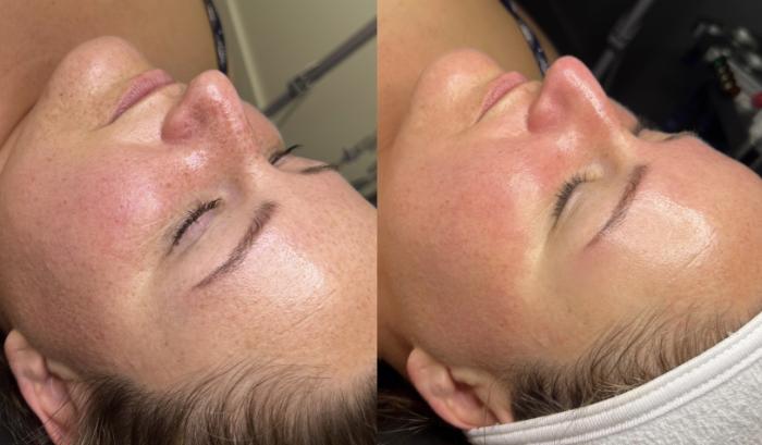 Before & After Facials Client #49 Left Side View in Tampa Bay, North Palm Beach, FL