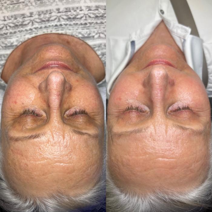 Before & After Facials Client #51 Front View in Tampa Bay, North Palm Beach, FL