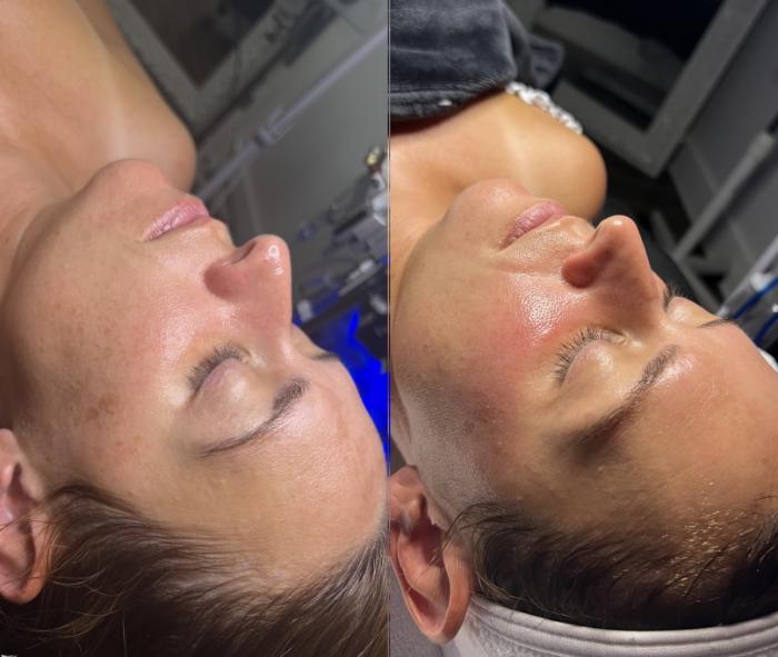 Before & After Facials Client #55 Left Side View in Tampa Bay, North Palm Beach, FL