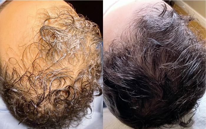 Before & After Hair Loss Treatment Client #11 Front View in Tampa Bay, North Palm Beach, FL