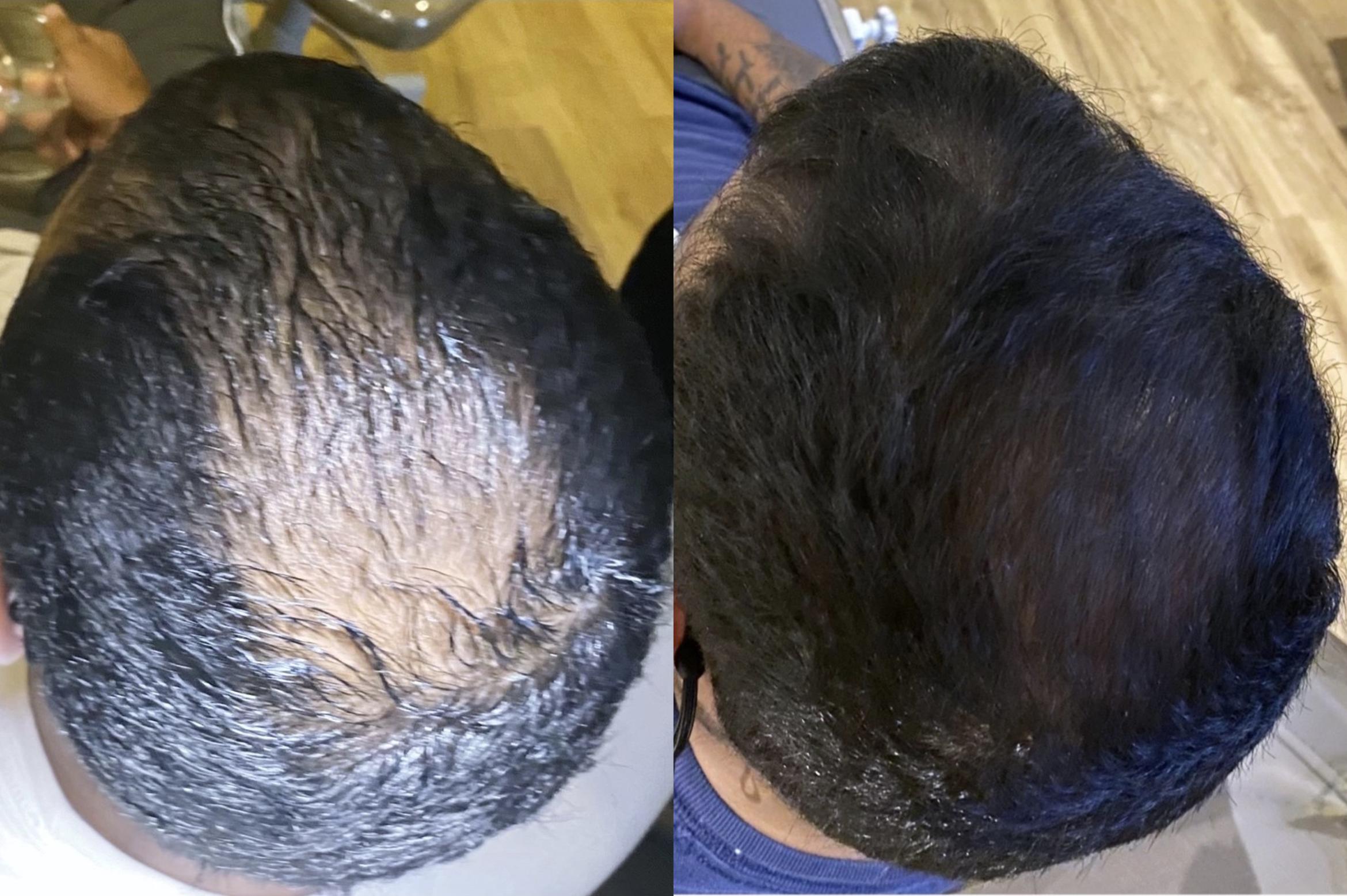 Before & After Hair Loss Treatment Client #15 Front View in Tampa Bay, North Palm Beach, FL