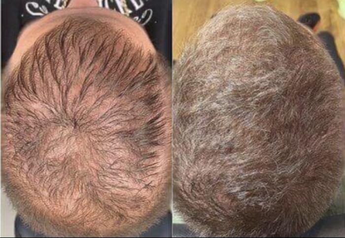 5 Months of Hair Restoration Treatments 