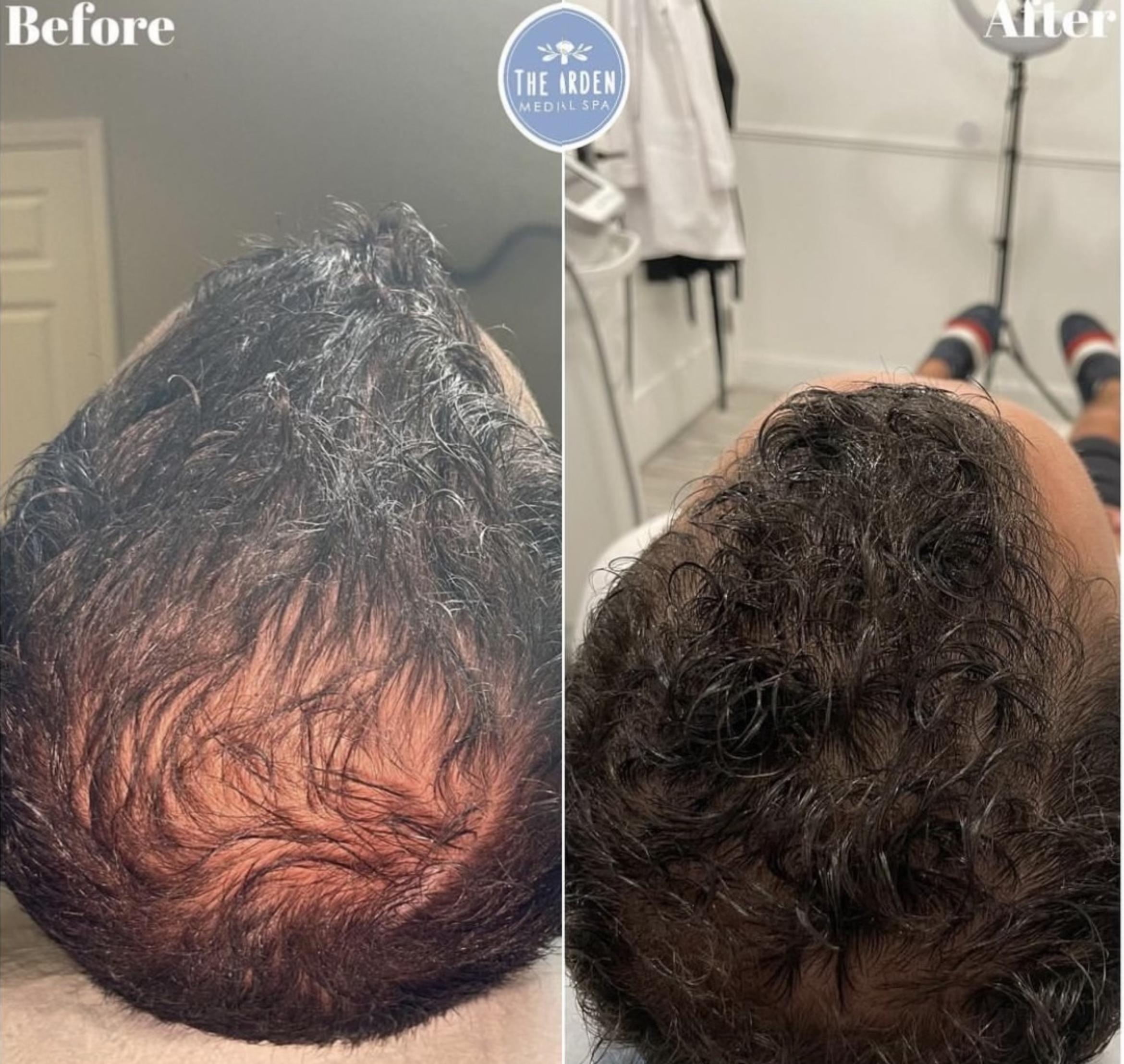 Before & After Hair Loss Treatment Client #72 Front View in Tampa Bay, North Palm Beach, FL