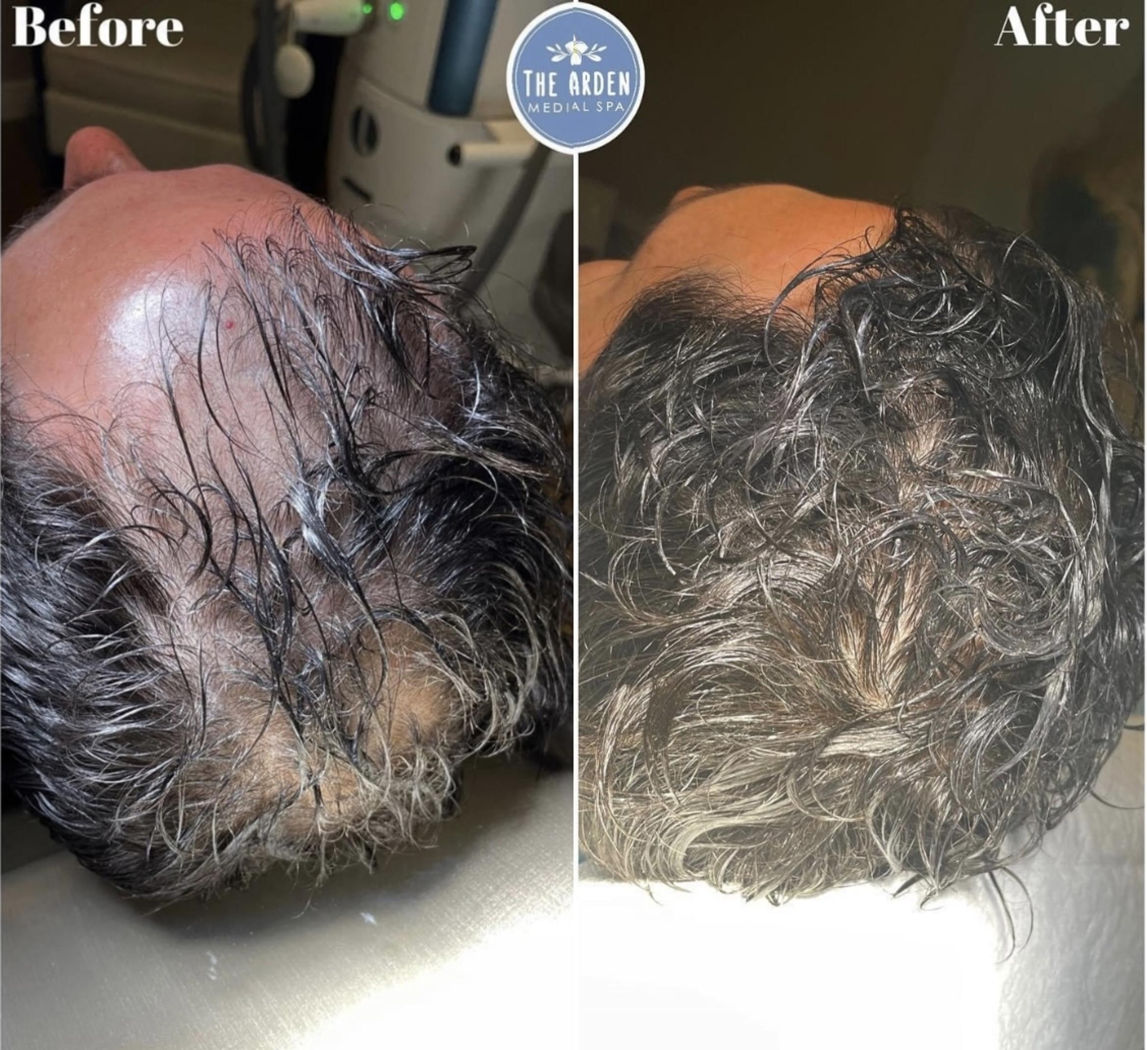 Before & After Hair Loss Treatment Client #86 Front View in Tampa Bay, North Palm Beach, FL