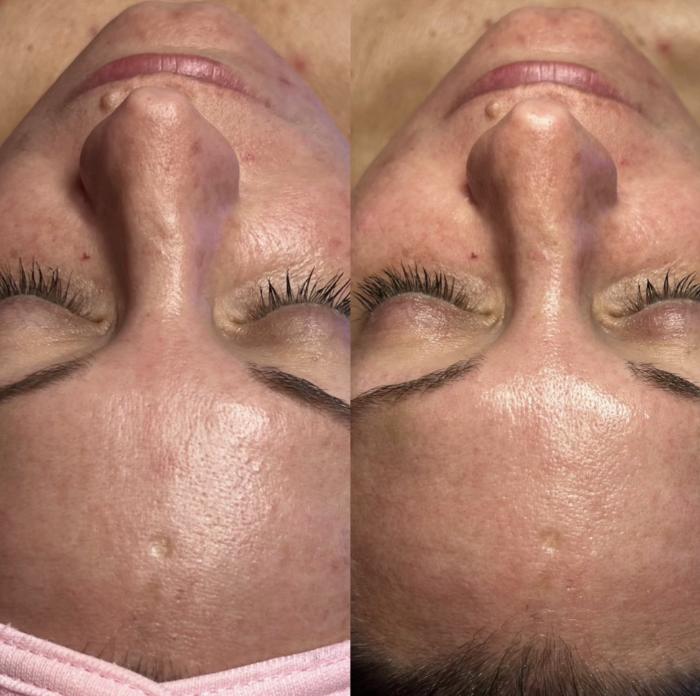 Hydrafacial: Rejuvenate and Hydrate