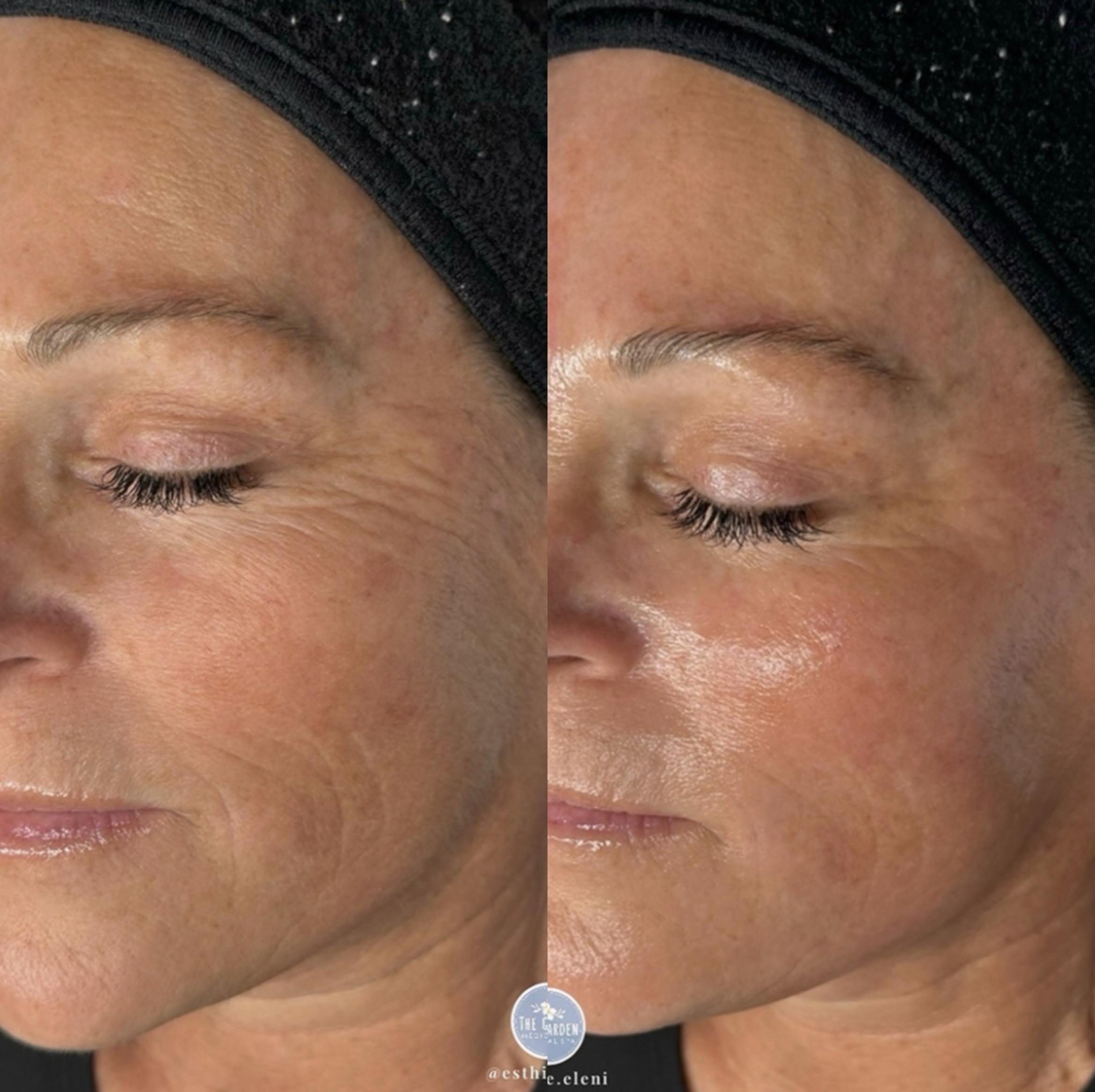 Hydrafacial for Hydration