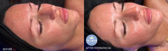 Hydrafacial for Hydration