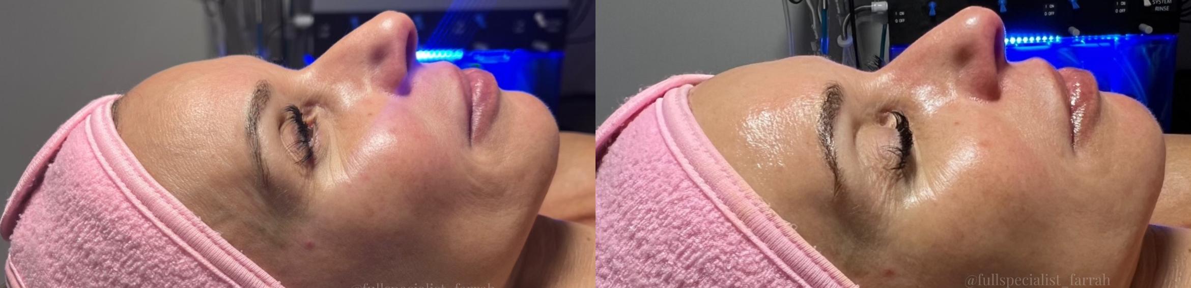 Before & After Hydrafacial™ Client #25 Right Side View in Tampa Bay, North Palm Beach, FL