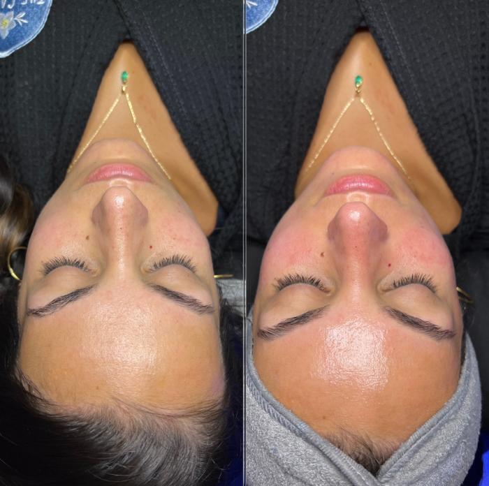 Before & After Hydrafacial™ Client #29 Front View in Tampa Bay, North Palm Beach, FL