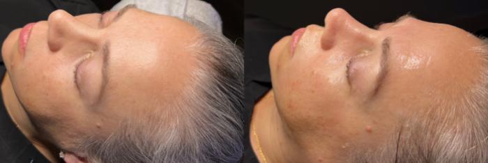 Before & After Hydrafacial™ Client #36 Left Side View in Tampa Bay, North Palm Beach, FL