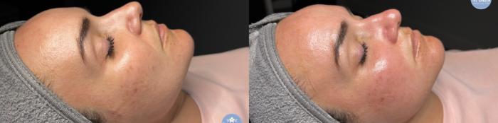 Before & After Hydrafacial™ Client #38 Right Side View in Tampa Bay, North Palm Beach, FL